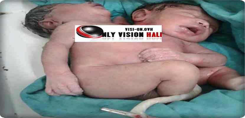 صورة للتوأم الملتصق